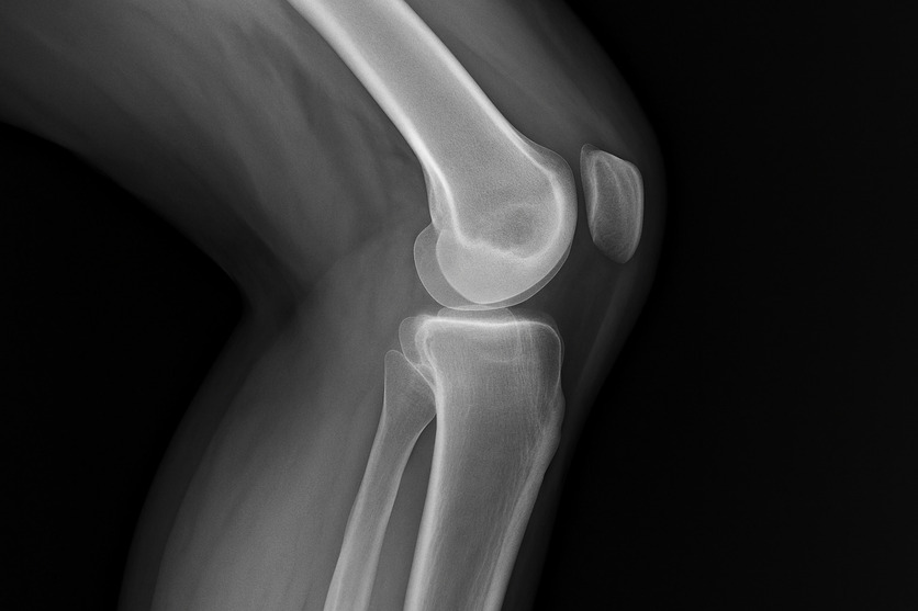 radiografia ginocchio